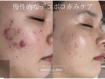 クレア(CLEA)/繰り返す慢性的なニキビケア