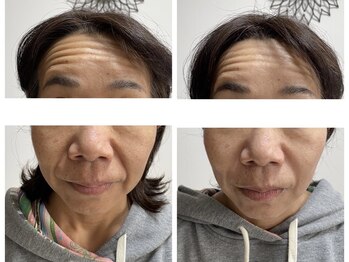 サクラ(SAKURA)/年齢問わず【小顔】効果絶大◎