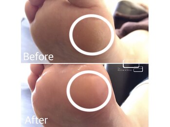 キュアバイアニーアンドジーノ(Qa by Annie&Gino)/夏に向けて角質ケア