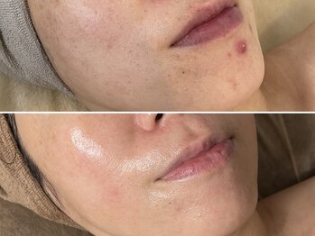 エイプリルフールズ(April fools)/【40代】繰り返すニキビが改善