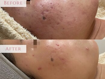 エミュ(emu)/敏感ニキビもお任せあれ