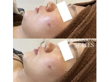 サロン ド グレイシャス エステティック(Salon de GRACIOUS esthetic)/光フェイシャル