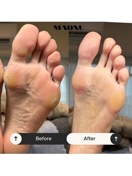 マオヌー(MAONU)/韓国式足裏角質ケア