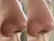 サロン ド ミューナ(salon de Myu-na)の写真/【山科初】あれ肌きれいになった？と言わせる劇的毛穴ケア★
