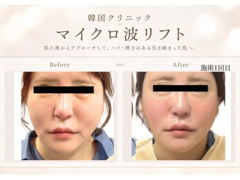 ナナイロ(nanairo)の写真/【韓国クリニック発】マイクロ波リフトで速攻小顔へ♪フェイスラインをキュッと引き締め憧れの韓国美人顔