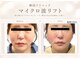 ナナイロ(nanairo)の写真/【韓国クリニック発】マイクロ波リフトで速攻小顔へ♪フェイスラインをキュッと引き締め憧れの韓国美人顔