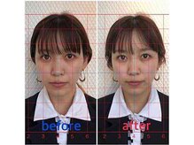 ルディア 堀江店(ledia)/美容鍼1回での変化