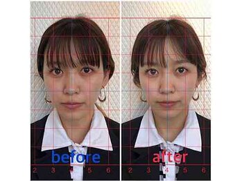ルディア 堀江店(ledia)/美容鍼1回での変化