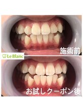 ルブラン 奈良店(Le Blanc)/中学生もホワイトニング！！