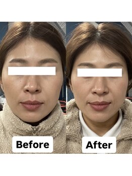 ヒューマン鍼灸接骨院/むくみ、フェイスアップ鍼