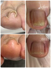 リゼラアンドコー 布施店/巻き爪ジェルでケア！