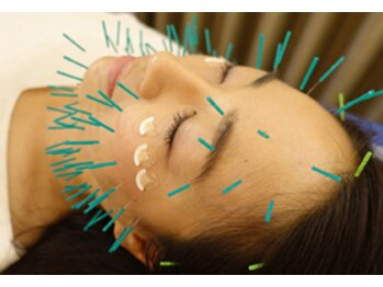 中国鍼灸院 はこしま医針堂/100本美容鍼