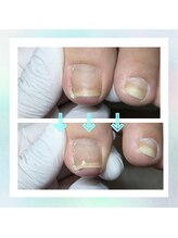 かとり台整骨院 つくば/陥入爪のケア