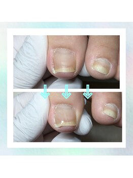 かとり台整骨院 つくば/陥入爪のケア