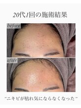 レイ(Rey)/ニキビケアフェイシャルワックス