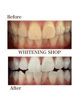 ホワイトニングショップ 川越店/【Before After】