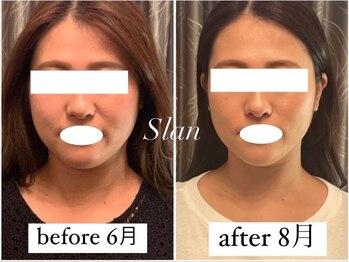 スラン(Slan)/小顔ケア