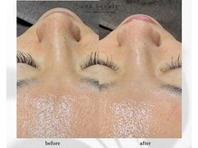 アン ビューティー(ann beauty)/施術1回【症例写真】40代