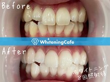 ホワイトニングカフェ 秋葉原店(WhiteningCafe)/◎歯のホワイトニング施術写真