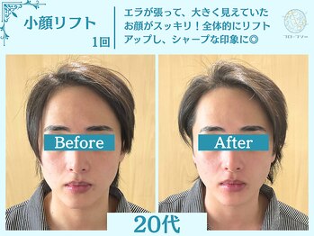 フローフシ∞/【小顔】切らない小顔リフト