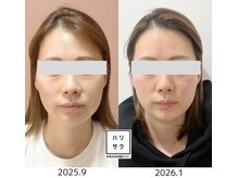 ハリサク/【症例写真】4ヶ月before→after