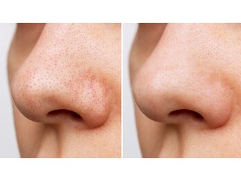 プライマルビューティ 艶 本店(Primal Beauty)/毛穴洗浄でお肌スッキリ♪