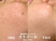 リル 和歌山市店(lilou)/ララピールBefore after