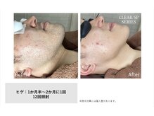 マイプラ(mypla)/メンズヒゲ