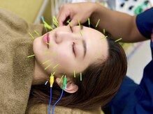 戸田みんなの鍼灸整骨院/パルスはリフトアップ効果大◎
