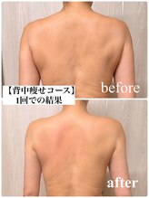バービーグロウ 恵比寿(Barbie Glow)/背中集中コース1回での結果
