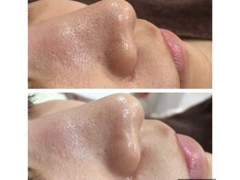 パールピーチ(total beauty place pearl peach)/毛穴洗浄ケア