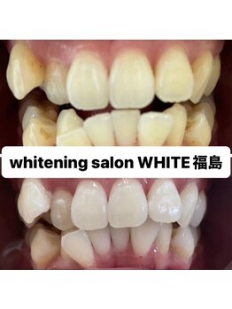 ホワイトニングサロン ホワイト(WHITE)/セルフホワイトニング