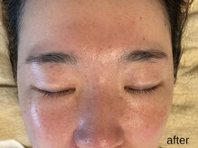 サロン ド エメ(salon de aimer)/【After】透明感！毛穴縮小！
