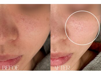 マグノリア(Magnolia)/酵素洗顔×超音波毛穴洗浄*毛穴