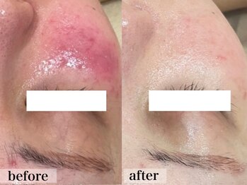 エステサロン ジョアアンジェ(joie ange)/赤みも軽減するララピール