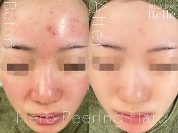 ベル 本八幡(Belle)/ハーブピーリング｜ニキビケア