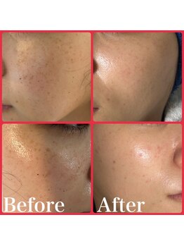 オルズ(Olu's)/ハーブピーリング｜シミケア