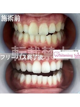 ホワイトニングサロン 福岡博多店/ホワイトニング
