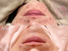 ヴェアリー 広尾(VARY)の雰囲気（水玉リフティング+ハーブピーリング症例。5回施術）