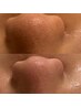 【学生限定】キッズオーヴル毛穴フェイシャル13200円→2980円