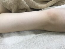 ナノハナ/鹿沼市本格全身脱毛ナノハナ