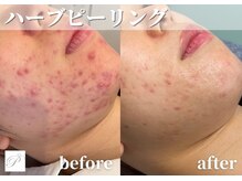 パールホワイトニングサロン 茅ヶ崎店/ハーブピーリング