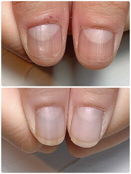 スマイルニコ(smile nico)/親指成長シリーズ　ご来店4回目