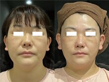 ソイズ 新保店(SOIS)/コルギで小顔に