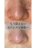 【脱！いちご鼻】毛穴エクストラクションプロ<角栓・黒ずみ>80分
