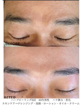 デコアイ(Deco eye)/40代男性 フルオプ1回での効果