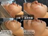 【ニキビケア×小顔】REVIハーブピーリング＋小顔ケアでフェイスライン強化