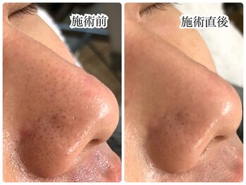 シェミー(CHEZ MEE)/【メンズ美容】毛穴洗浄/黒ずみ