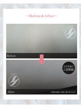 ノノ(nono)/太ももの脱毛