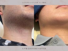シエスタビューティラボ/【ヒゲ脱毛】卒業後もサポート